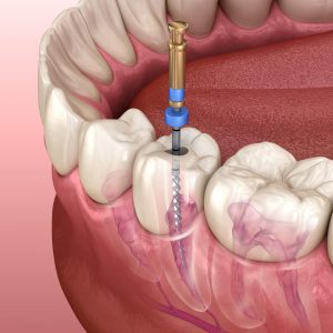 Endodoncia-lo-que-necesitas-saber.jpg